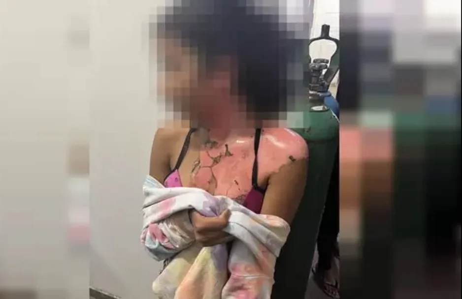 Vítima foi queimada com água quente pela tia no DF