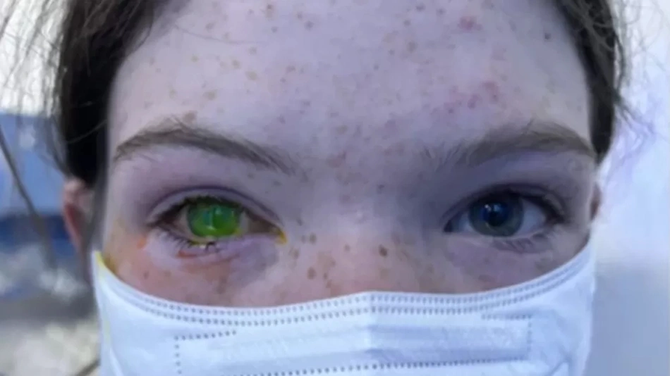 Doença que muda a cor do olho causa alerta na Austrália